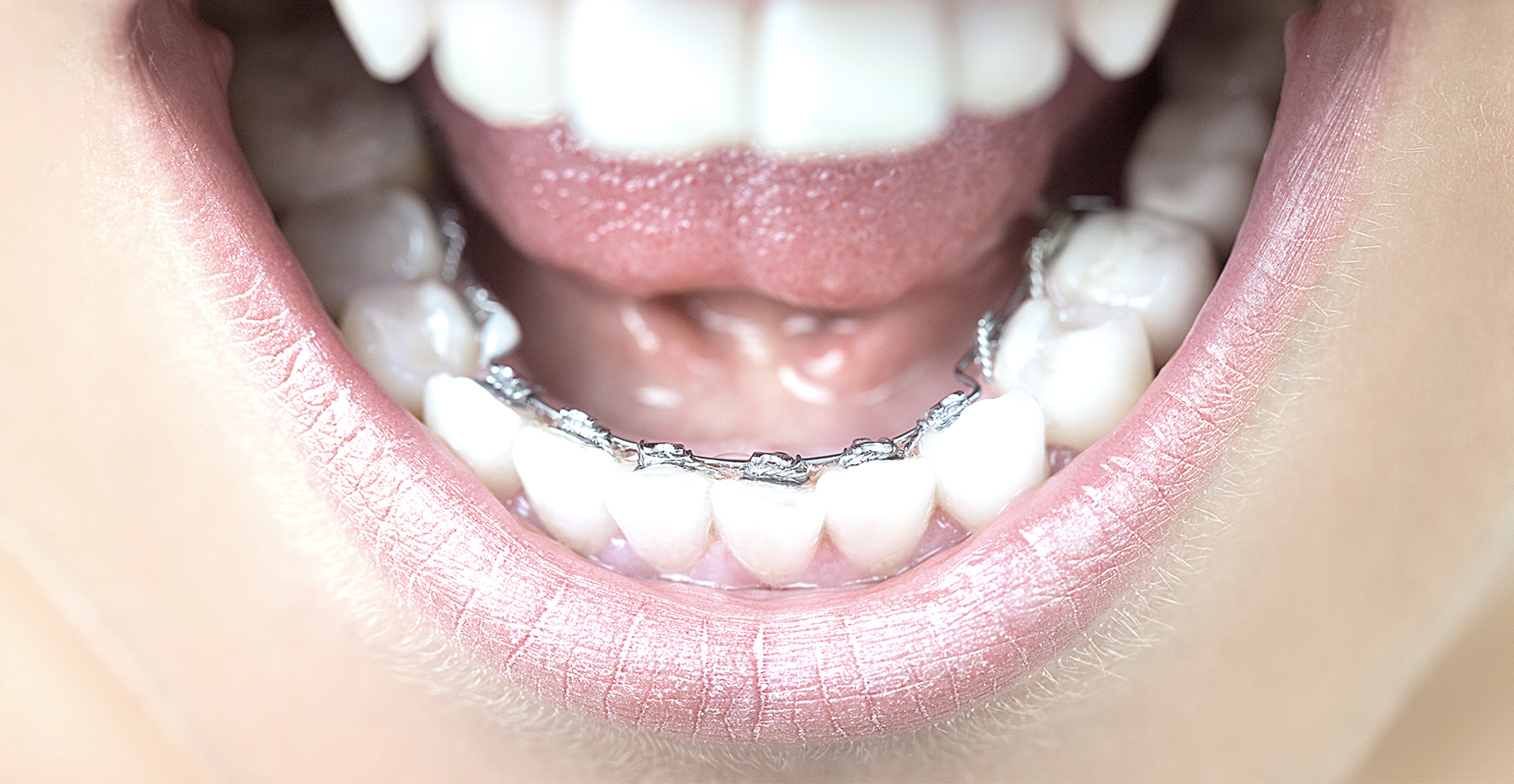 unsichtbare Spangen - KiO4U – Ihre Zahnarztpraxis in Gera